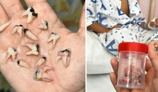 Bé trai phải nhổ 12 răng cùng lúc vì thói quen tưởng vô hại nhưng cực nguy hiểm