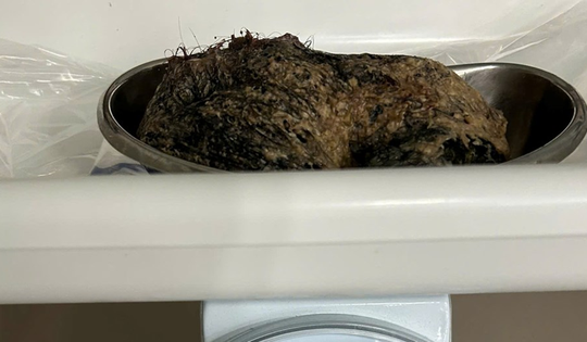 Bé gái 6 tuổi đau bụng dữ dội, bác sĩ gắp ra thứ "đáng sợ"