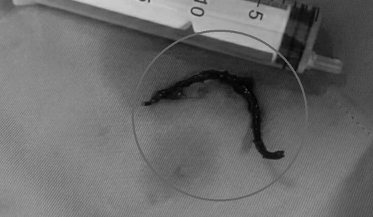 Người phụ nữ đau họng kh&#244;ng chịu nổi, b&#225;c sĩ gắp ra thứ &quot;đ&#225;ng sợ&quot;