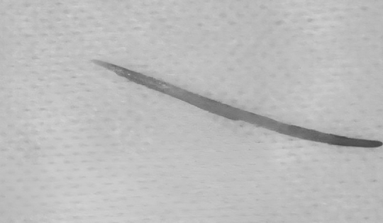 Người đàn ông 57 tuổi đau bụng thốc ngược lên, bác sĩ gắp ra thứ "đáng sợ" dài 5cm