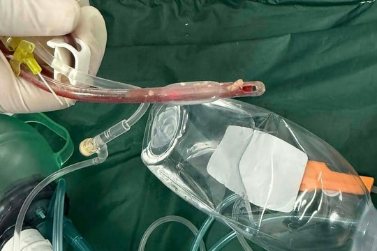 Bé 3 tuổi tử vong sau khi sặc thức ăn tại nhà trẻ