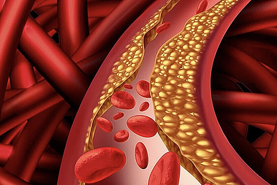 Vì sao ăn uống, tập thể dục điều độ nhưng mỡ máu vẫn cao?
