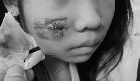 Đang chơi ở sân nhà, bé 8 tuổi bị khỉ tấn công, vết thương phức tạp