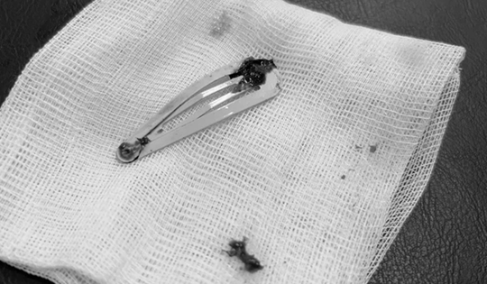 Bé gái 6 tuổi được cô giáo đưa đến viện, bác sĩ gắp thứ dài 7cm trong bụng