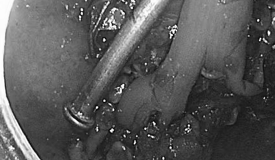 Bé trai 8 tuổi nghịch dại, bác sĩ kinh ngạc phát hiện thứ "đáng sợ" bên trong bụng