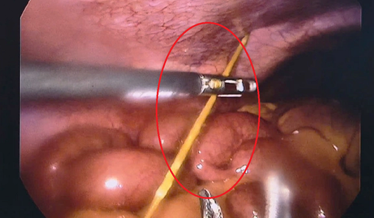 Đau bụng dữ dội, bác sĩ phát hiện thứ "đáng sợ" bên trong