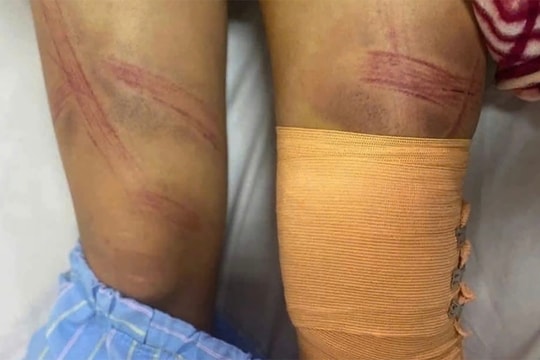 Bé gái 12 tuổi bị bố đánh nhập viện