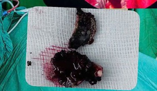 Chảy nước mũi hôi nhiều năm, bệnh nhân 23 tuổi đi khám bác sĩ gắp ra thứ "đáng sợ"