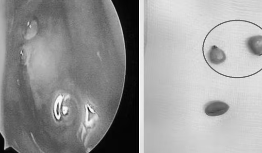 Bé trai hơn 2 tuổi chảy mũi hàng ngày, bác sĩ phát hiện ra "bí mật" đáng sợ