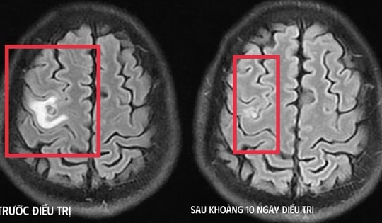 Cơn co giật bất thường hé lộ “vị khách lạ” ký sinh trong não