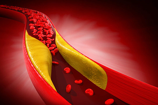 Vì sao tập gym vẫn mỡ máu cao?