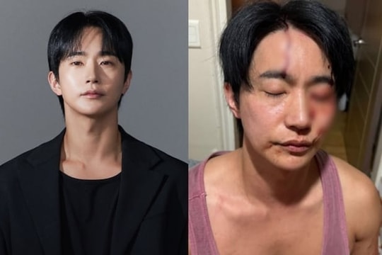 Nam diễn viên bị bạn gái cũ bạo hành