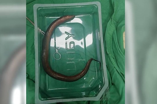 Thủng ruột vì nhét lươn dài 30 cm qua hậu môn