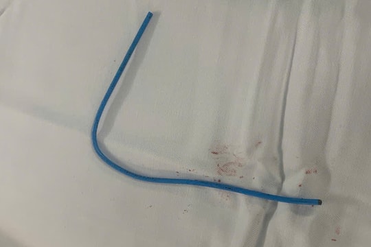 Ống truyền hóa chất ung thư đứt rời trôi vào tim bệnh nhân