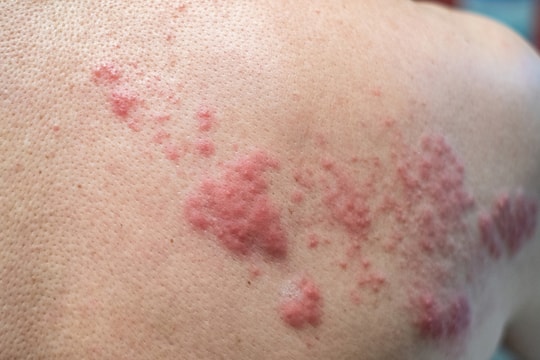 Bạn có hiểu sai về bệnh zona thần kinh?