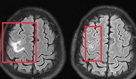 Người đàn ông 39 tuổi đau đầu, bác sĩ phát hiện thứ "đáng sợ" bên trong
