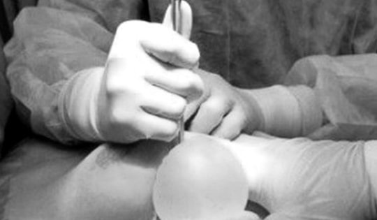 Người phụ nữ 30 tuổi bị hoại tử ngực vì tiêm chất làm đầy