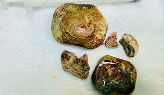 Người đàn ông 43 tuổi "bụng cứng như đá", bác sĩ phát hiện bí mật "đáng sợ"