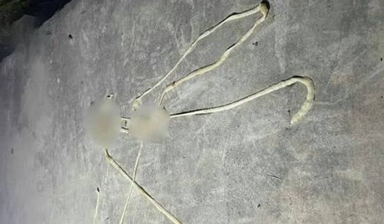 Bị rối loạn tiêu hóa, người đàn ông phát hiện "vật thể lạ" dài gần 10m