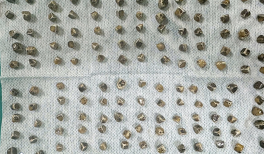 Đau bụng đi khám, người phụ nữ 40 tuổi sốc khi bác sĩ gắp ra thứ "đáng sợ" bên trong