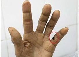 Vết thương nhỏ khiến người phụ nữ nhiễm khuẩn uốn ván