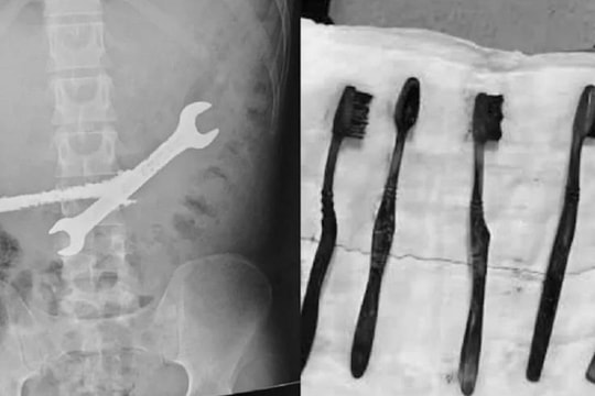 Bác sĩ lấy 2 cờ lê sắt và 7 bàn chải từ bụng nam thanh niên