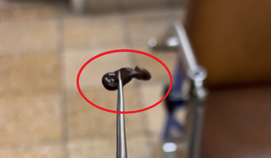 Bé trai 4 tuổi rỉ máu mũi kéo dài, bác sĩ gắp ra thứ "đáng sợ" bên trong