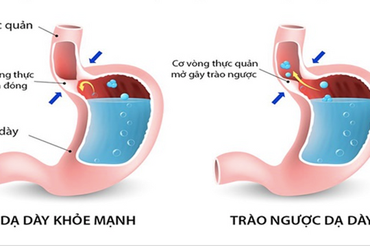 Ai dễ bị trào ngược dạ dày - thực quản?