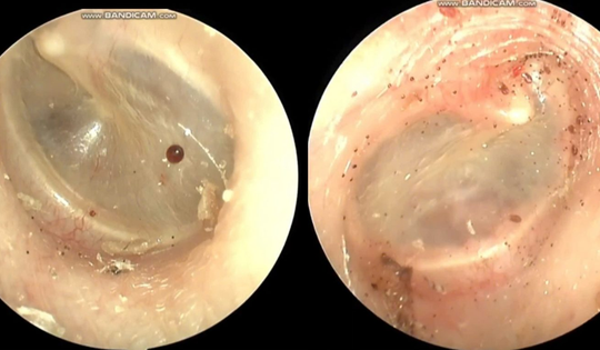 Người phụ nữ 60 tuổi tai ngứa như kim châm, bác sĩ gắp ra thứ "đáng sợ" bên trong