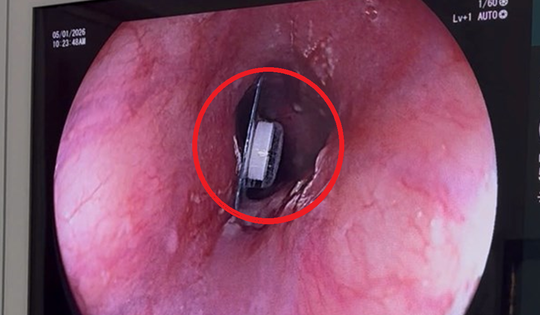 Người phụ nữ 60 tuổi đau ngực thốc ngược lên, bác sĩ phát hiện bí mật "đáng sợ" bên trong