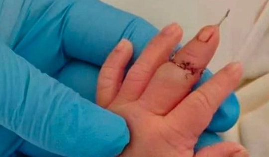 Nữ hộ sinh làm đứt ngón tay bé trai khi cắt dây rốn