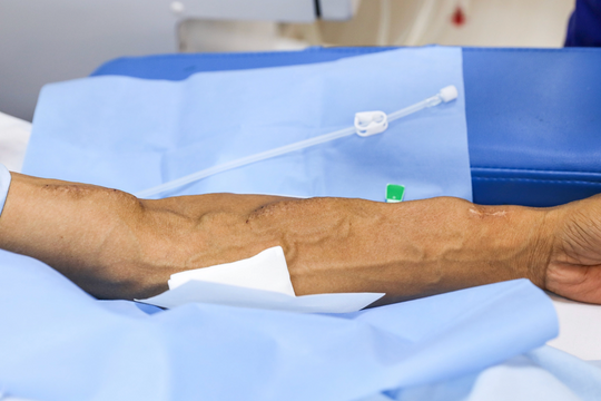 Nước tiểu thay đổi thế nào khi thận suy?