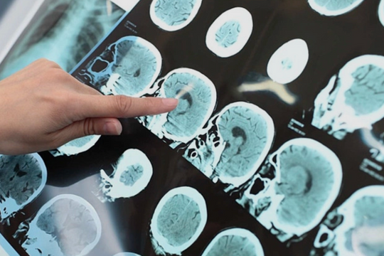 Những 'cú sốc nhiệt' kích hoạt đột quỵ khi trời lạnh