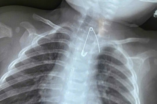 Chiếc kim băng găm vào thực quản bé 7 tháng tuổi