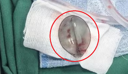 Bé 4 tuổi nôn ra máu, bác sĩ phát hiện thứ "đáng sợ" bên trong