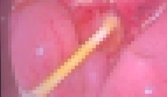 Bé 5 tuổi đau bụng kéo dài, gia đình sốc nặng khi bác sĩ gắp ra thứ "đáng sợ" trong bụng bé