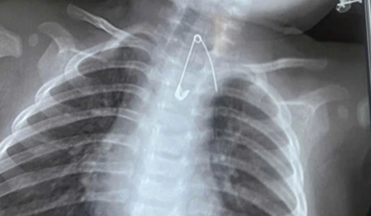 Bé 7 tháng tuổi khò khè kéo dài, bác sĩ phát hiện bí mật "đáng sợ"