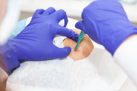 Sinh thiết khiến ung thư nặng hơn?