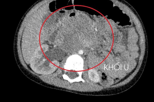 Bé 3 tuổi bị ung thư tinh hoàn