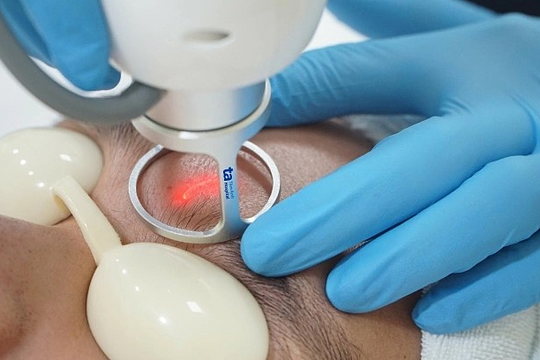 Bị sẹo rỗ vì trị thủy đậu sai cách