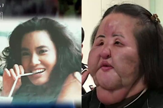 Bi kịch thẩm mỹ hỏng của ca sĩ 'mặt quạt'