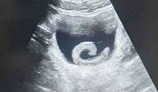 Đi siêu âm, người đàn ông sốc nặng khi thấy con vật "bơi" trong bụng mình