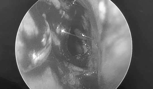 Đi khám, người đàn ông sốc nặng khi bác sĩ thấy thứ "đáng sợ" trong mũi mình