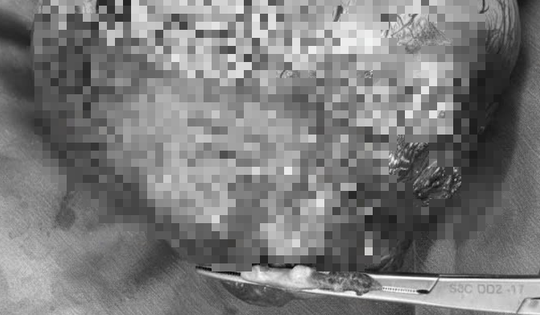 Đi siêu âm, người đàn ông sốc nặng khi thấy vật thể "lạ" khổng lồ trong ổ bụng