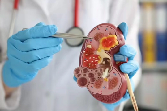 Bác sĩ cảnh báo thói quen phổ biến âm thầm gây hại thận