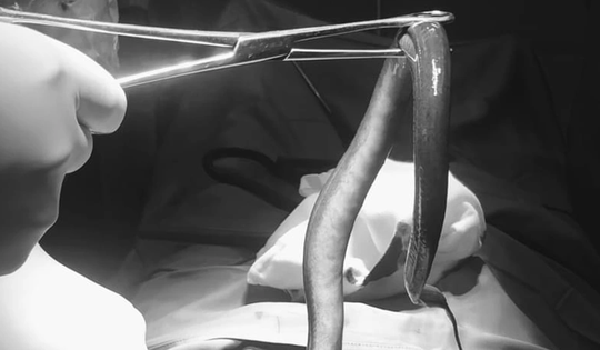 Bụng "cứng như gỗ", người đàn ông sốc nặng khi biết có con vật bơi trong bụng mình