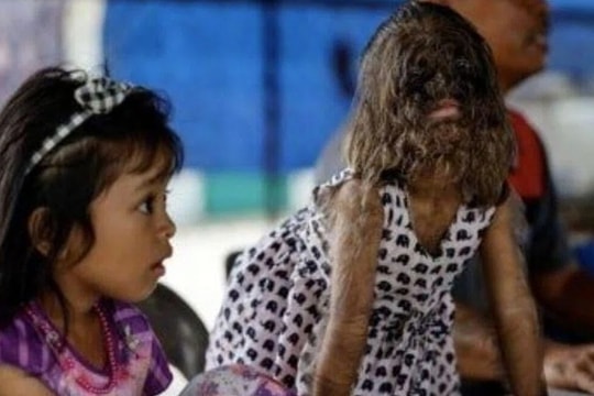 Chương mới cuộc đời cô bé 'người sói'