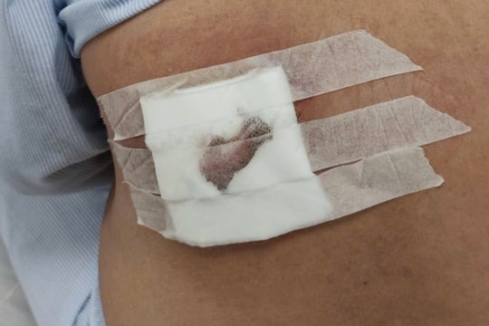 Hoại tử lưng, nguy kịch vì đắp lá chữa mụn nhọt