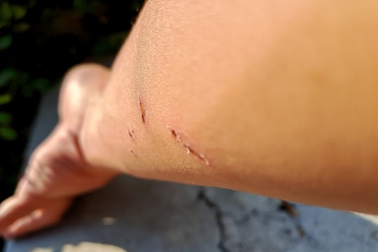 Vì sao người mắc bệnh dại vẫn tỉnh táo?