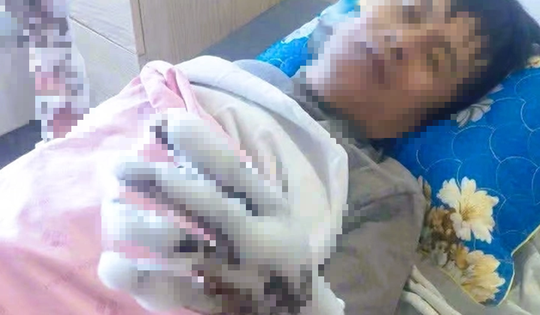 Bị phóng điện, người đàn ông bỏng nặng cả hai tay